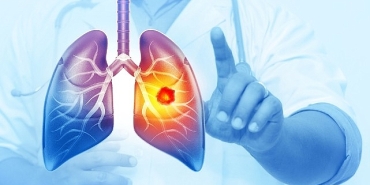 her-yil-25-bin-akciger-kanseri-vakasi-onlenebilir.jpg